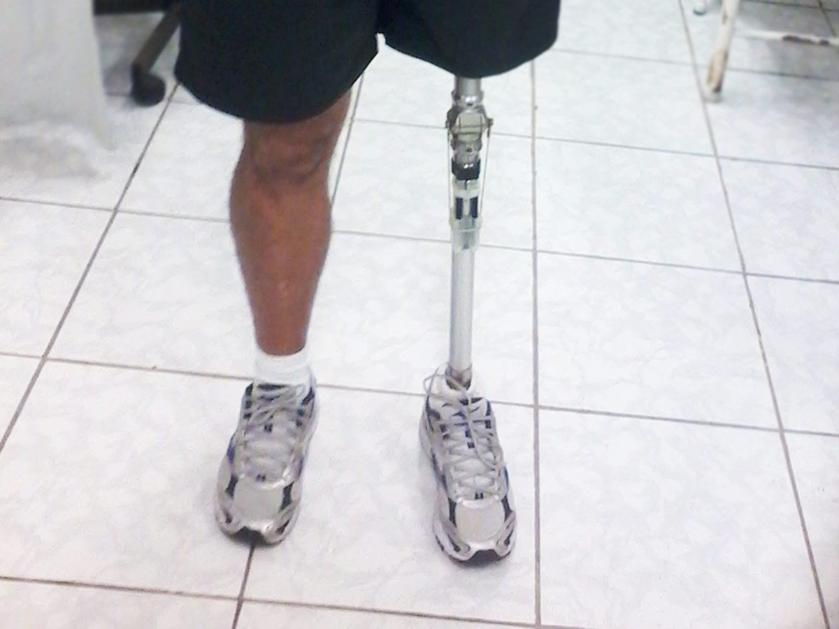 Confecção de Próteses em Santos