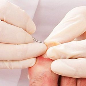 ortopel tratamento de unhas encravadas em santos