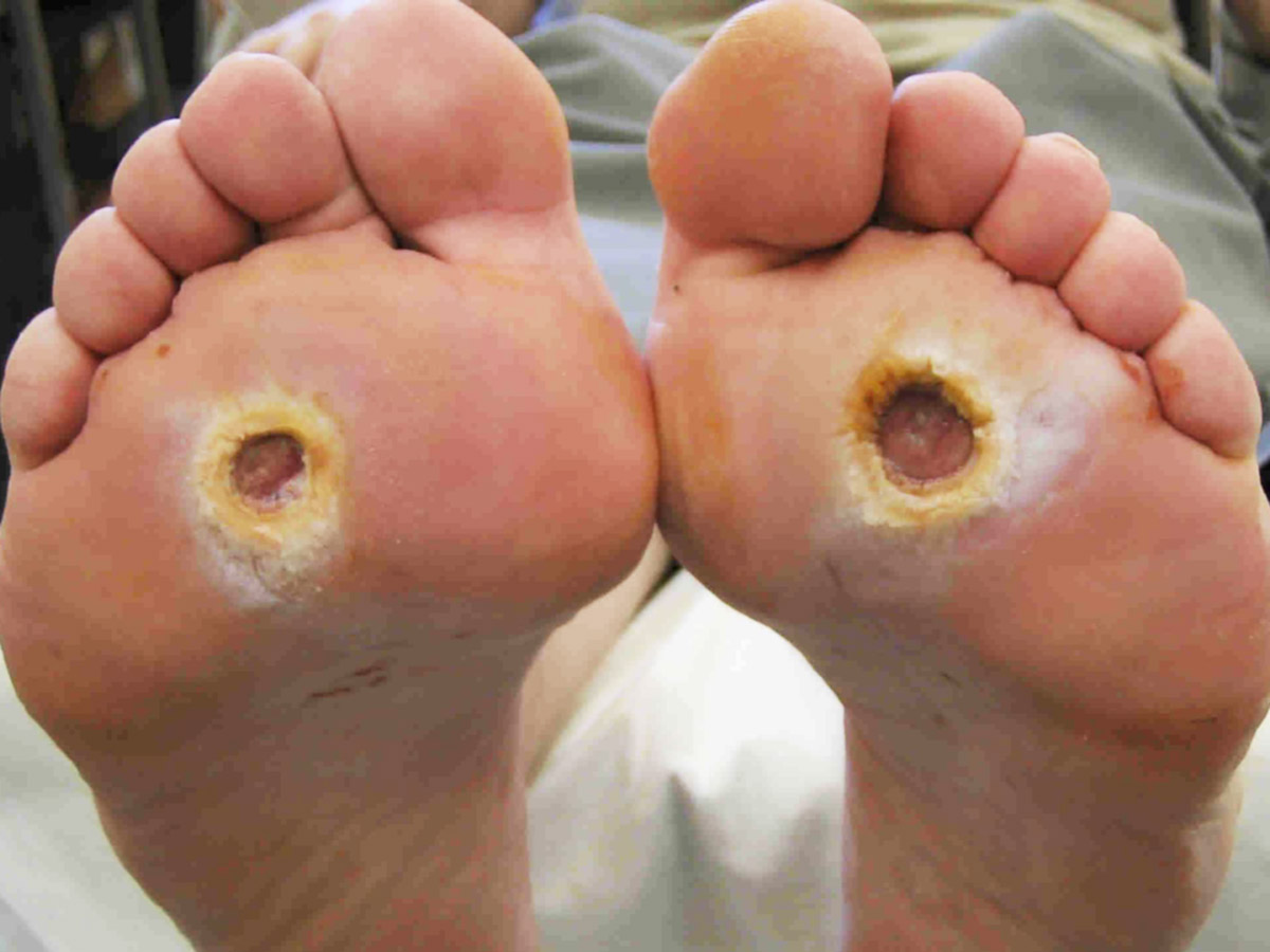 Tratamento de úlcera plantar