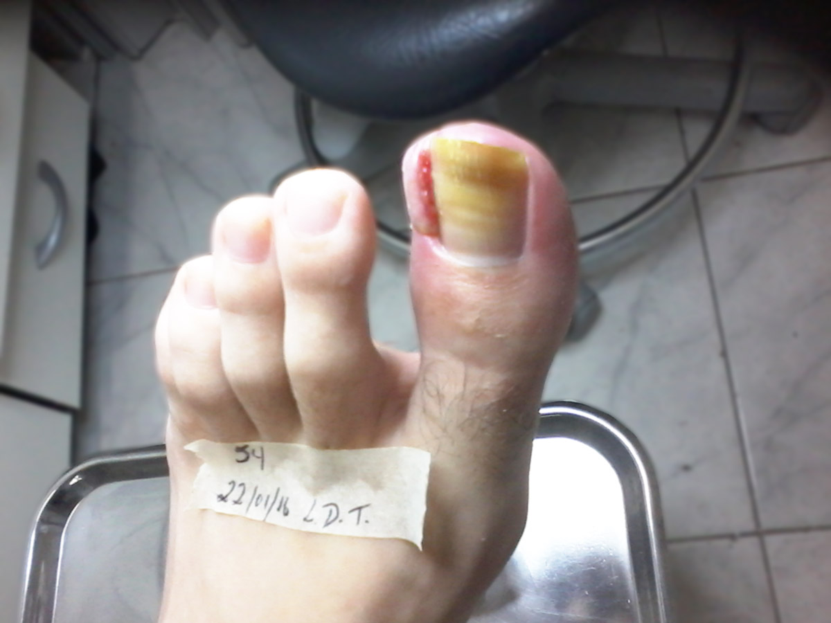 Trate sua micose nas unhas com a Ortopel Saúde