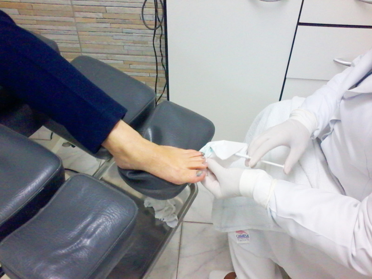 Tratamento de micose nas unhas em Santos - Ortopel Saúde