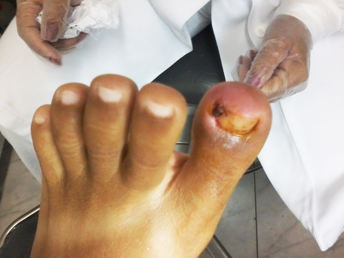 Tratamento de unhas encravadas em Santos - Ortopel Saúde